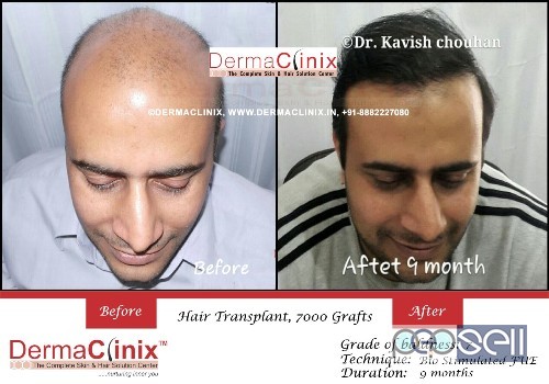 Best Hair Transplant Clinic In South Delhi | Hair Transplant Clinic | DermaClinix | @8882227080 2 
