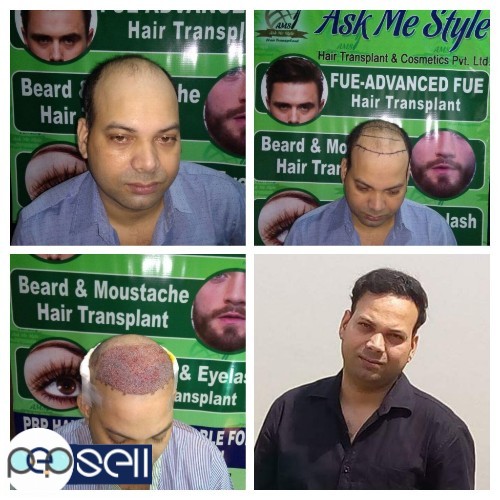 AMS Hair Transplant Center in Ludhiana Punjab | Ludhiana free classifieds