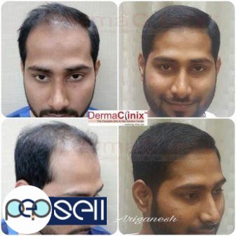 5 ACCURATE REASONS TO GET A HAIR TRANSPLANT RIGHT AWAY! 0 
