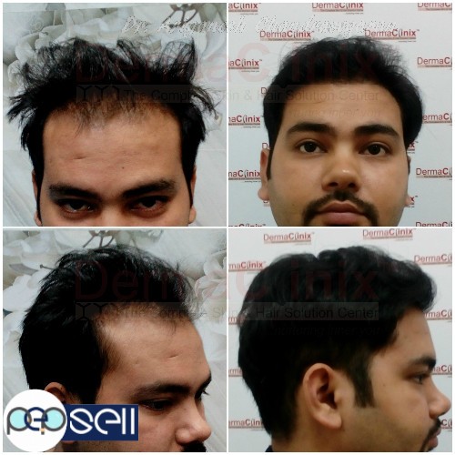 Best Hair Transplant Doctor in Chennai | Chennai free classifieds