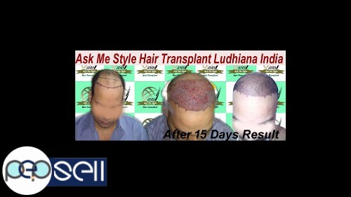 AMS Hair Transplant India || Best Hair Transplant Center Ludhiana Punjab 0 