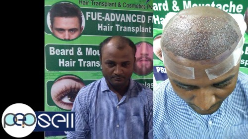 AMS Hair Transplant India || Best Hair Transplant Center Ludhiana… |  Ludhiana free classifieds