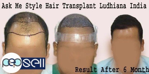 AMS Hair Transplant India || Best Hair Transplant Center Ludhiana Punjab 3 