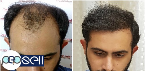 Hair Transplant Before After 0 