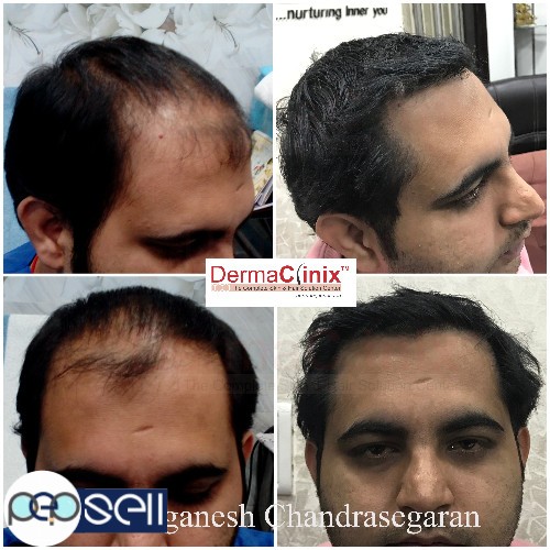 Reach the Best Clinic to Get Excellent Hair Transplantation in Chennai 0 