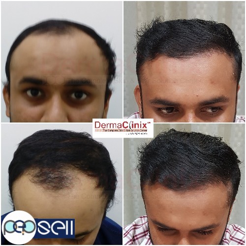 Best Hair Transplant in Delhi | New Delhi free classifieds