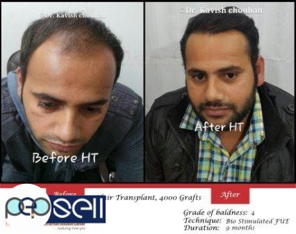 Hair Transplant Surgeon in India | New Delhi free classifieds