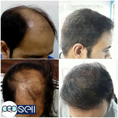 What are the Most Popular Techniques of Hair Transplant in Chennai? 0 
