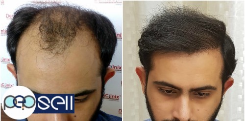 Hair Transplant Surgery in Delhi 0 
