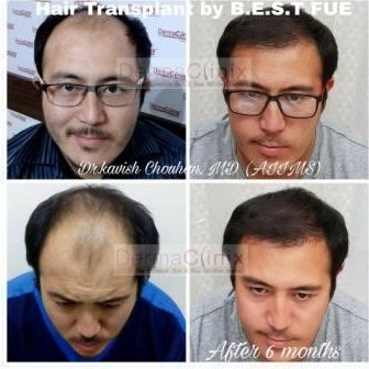 The Excellent And Result Oriented Hair Transplant in Delhi 0 