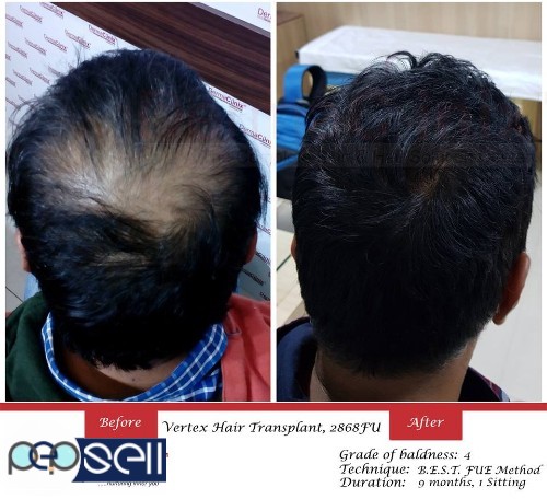 Which is the Delhiâ€™s Cheapest & Best Hair Transplant Clinic? 0 