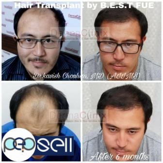 All About the Hair Transplant in Dermatology 0 