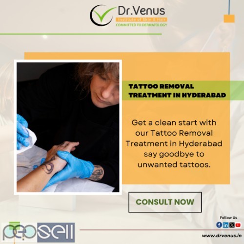 Tattoo Removal Treatment in Hyderabad 0 